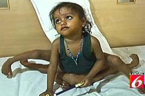 Индийской девочке удалили лишние руки и ноги - 20071108193020936_1
